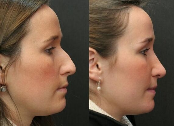 Antes y después de la rinoplastia no quirúrgica