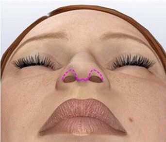 Corrección nasal