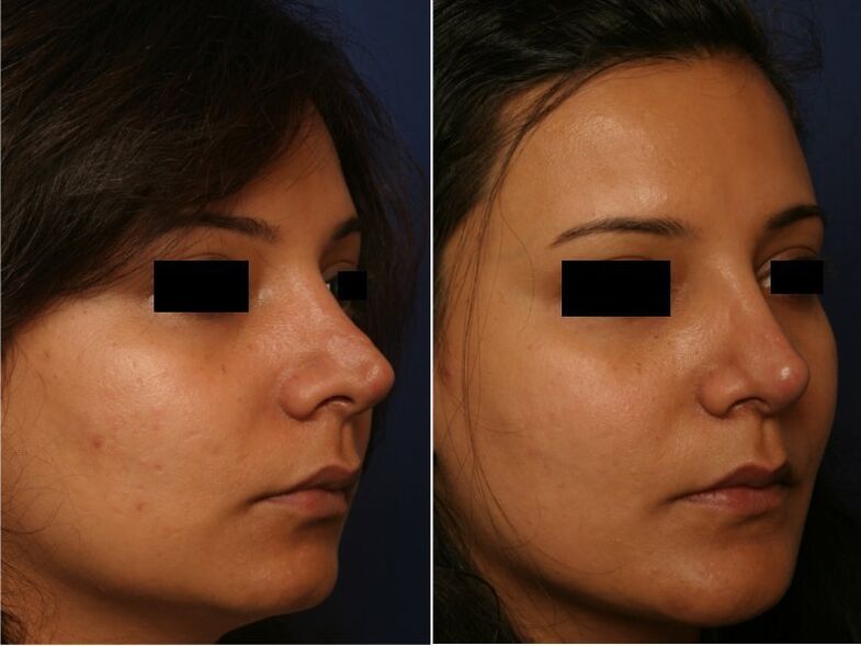 resultado de la cirugia plastica