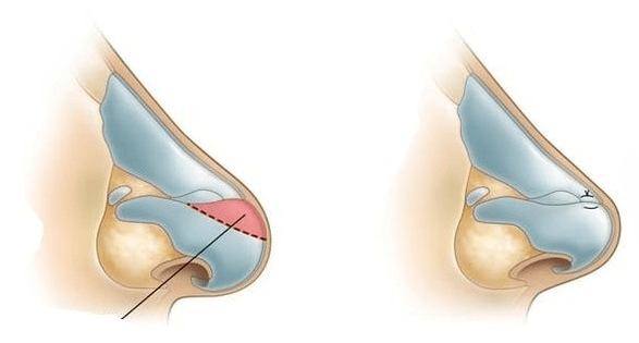 Corrección de la forma de la nariz