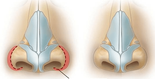 Reducción de fosas nasales