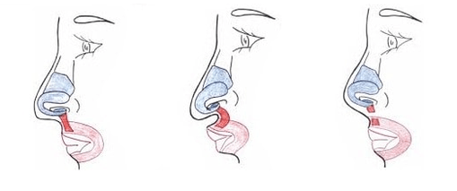 Truncamiento de parte del músculo nasal.