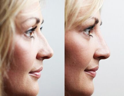 Antes y después de la rinoplastia con rellenos