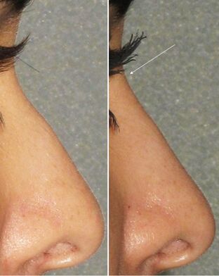 Antes y después de la rinoplastia no quirúrgica