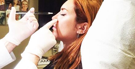 Procedimiento de rinoplastia con rellenos.