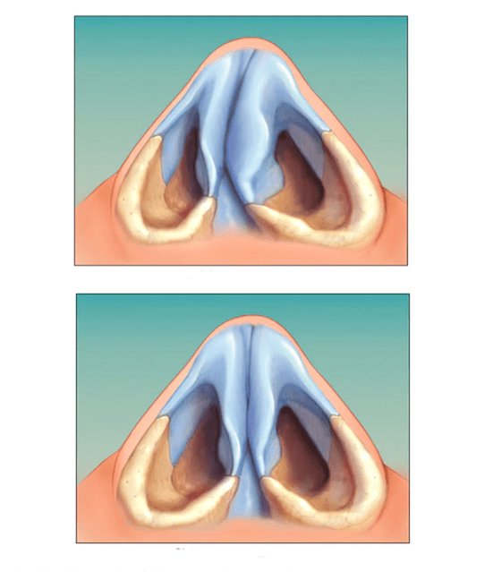 tabique nasal corregido