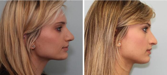 Resultados de la rinoplastia antes y después