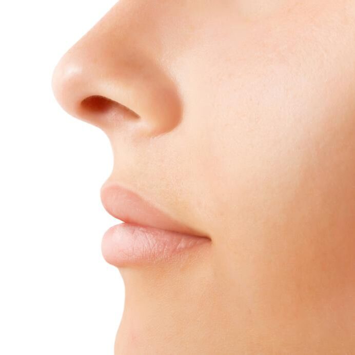 resultado de una rinoplastia abierta