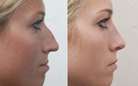 Antes y después de la rinoplastia no quirúrgica