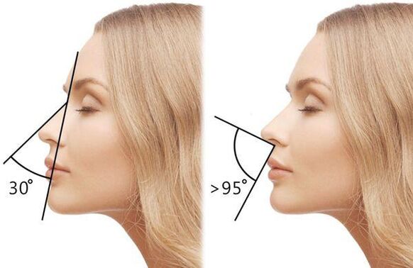 medición del ángulo de la nariz