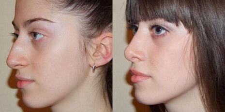fotos antes y después de la rinoplastia de nariz