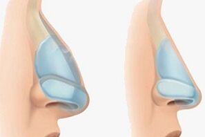 nariz antes y después de la rinoplastia
