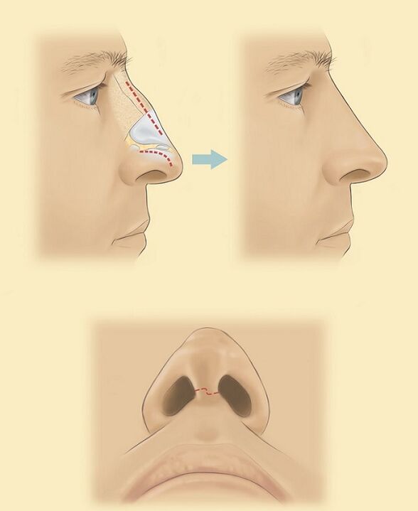 esquema para rinoplastia de la nariz