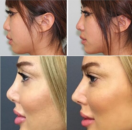 fotos antes y después de la rinoplastia no quirúrgica