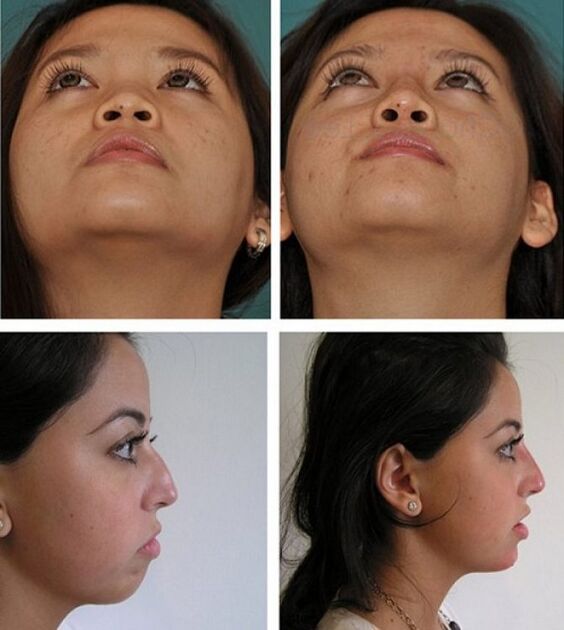 fotos antes y después de la rinoplastia sin cirugía