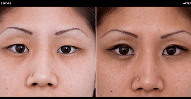 antes y después de la cirugía ocular