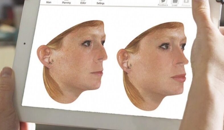 Método de modelado por computadora de la nariz antes de la rinoplastia. 