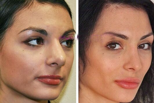 nariz antes y despues de la cirugia plastica