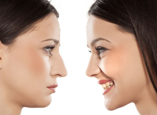 La rinoplastia de la nariz antes y después de la
