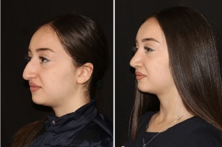 El resultado del alisado de la nariz después de la rinoplastia