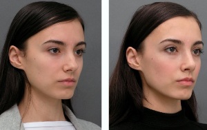 La chica de antes y después de la rinoplastia de la nariz