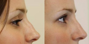 la punta de la nariz antes y después de la