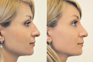 No quirúrgica la rinoplastia, la foto de antes y después de la